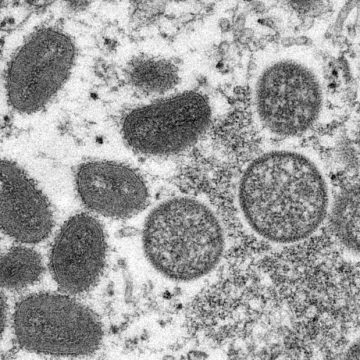 Die WHO muss erneut prüfen, ob der Ausbruch der Affenpocken ein Gesundheitsnotfall von internationaler Tragweite ist