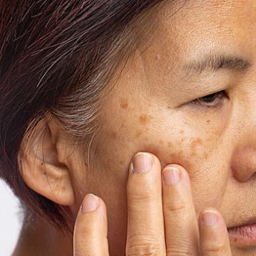 Melasma: Was sind die besten Behandlungen?