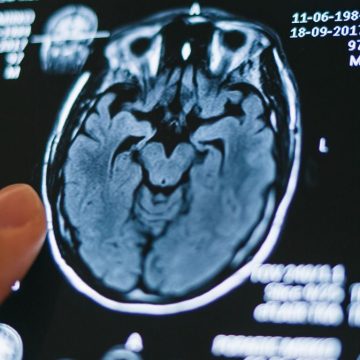 Aktuelle Richtlinien können die Schlaganfallversorgung unnötig verzögern