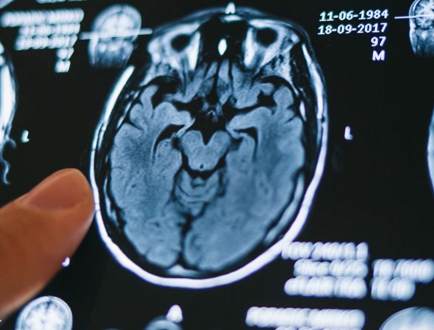 Aktuelle Richtlinien können die Schlaganfallversorgung unnötig verzögern