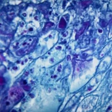 UVA Health teilt weniger bekannte Affenpocken-Symptome