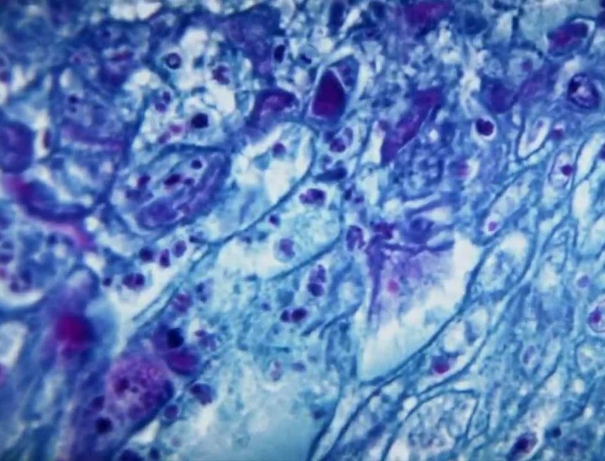 UVA Health teilt weniger bekannte Affenpocken-Symptome