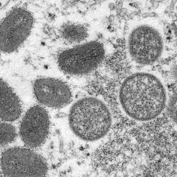 Das Gesundheitsamt von Dallas County erhöht die Zahl der Fälle von Affenpocken auf 14