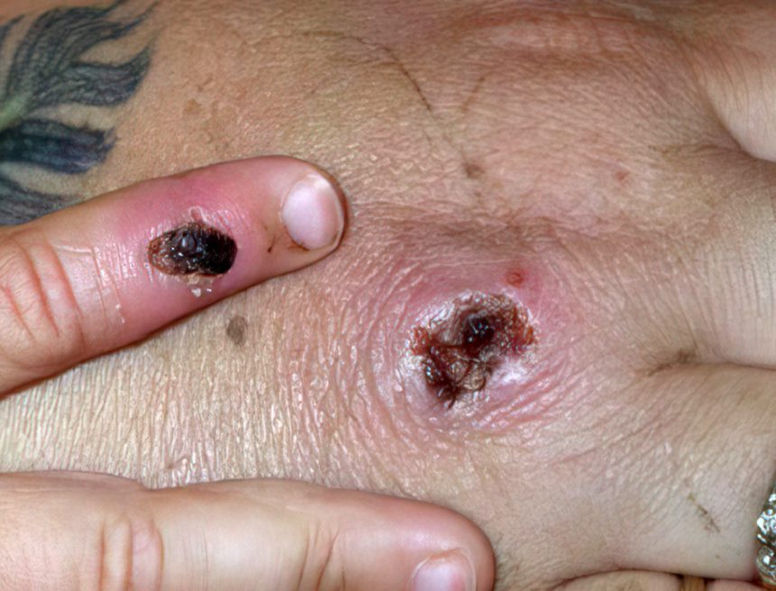 Iowa-Gesundheitsbeamte sagen, dass der erste wahrscheinliche Fall von Affenpocken im Bundesstaat gemeldet wurde